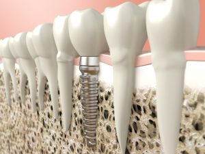 dental implant leesburg