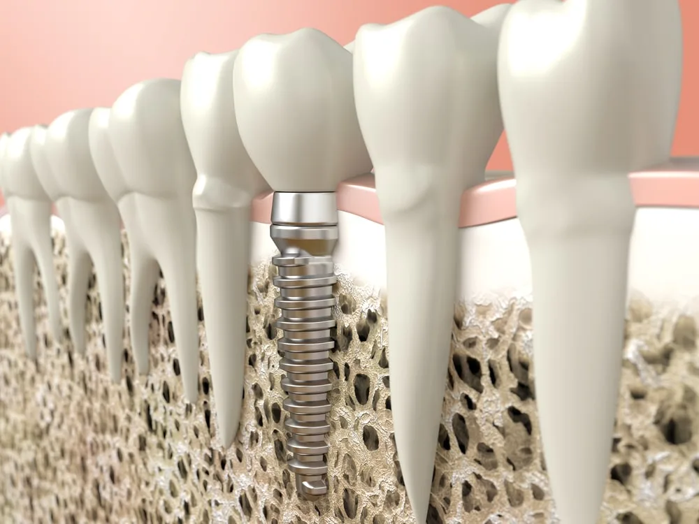 dental implant leesburg