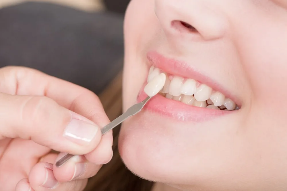 dental veneers leesburg