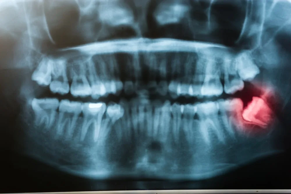 tooth extraction leesburg