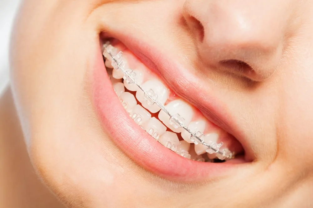 six month braces clear braces leesburg